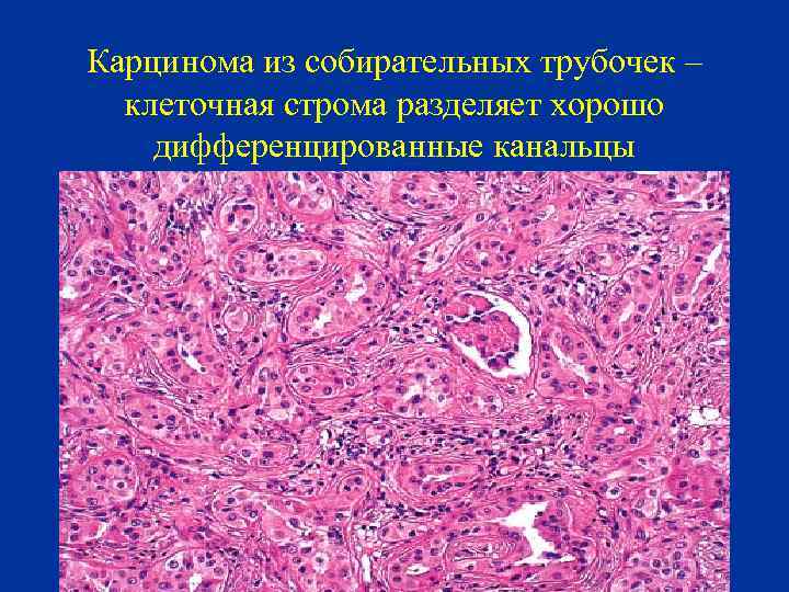 Карцинома из собирательных трубочек – клеточная строма разделяет хорошо дифференцированные канальцы 