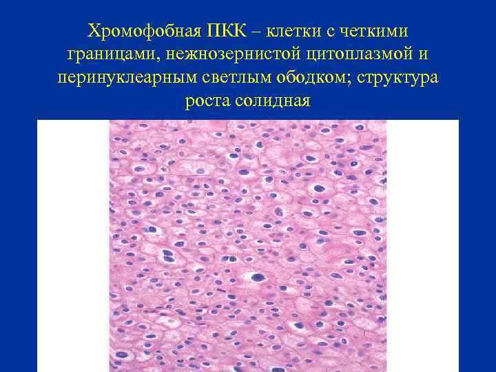 Хромофобная ПКК – клетки с четкими границами, нежнозернистой цитоплазмой и перинуклеарным светлым ободком; структура