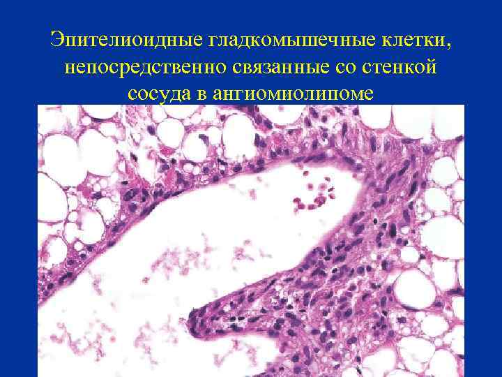 Эпителиоидные гладкомышечные клетки, непосредственно связанные со стенкой сосуда в ангиомиолипоме 