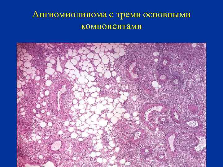 Ангиомиолипома с тремя основными компонентами 