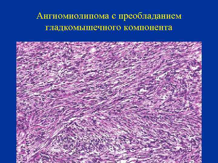 Ангиомиолипома с преобладанием гладкомышечного компонента 