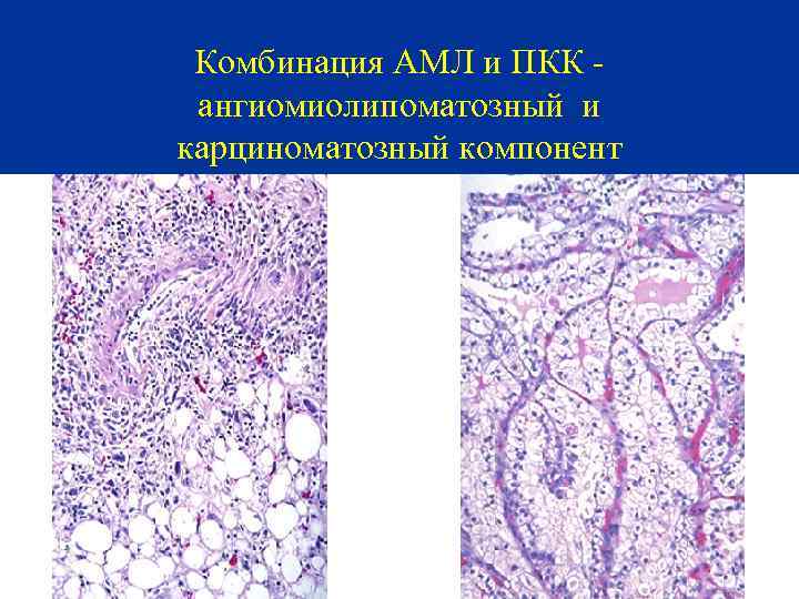 Комбинация АМЛ и ПКК ангиомиолипоматозный и карциноматозный компонент 