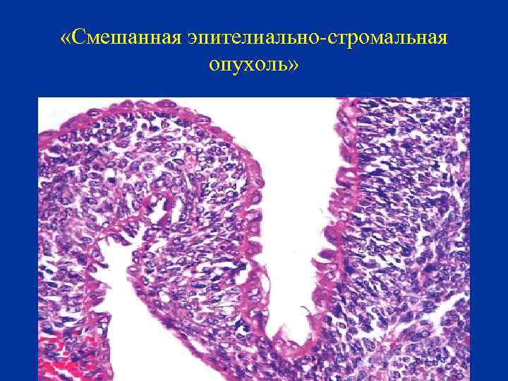  «Смешанная эпителиально-стромальная опухоль» 