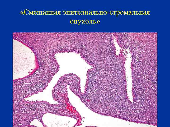  «Смешанная эпителиально-стромальная опухоль» 