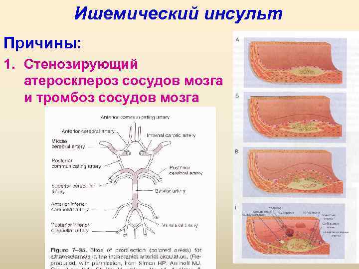 Ишемический инсульт Причины: 1. Стенозирующий атеросклероз сосудов мозга и тромбоз сосудов мозга 