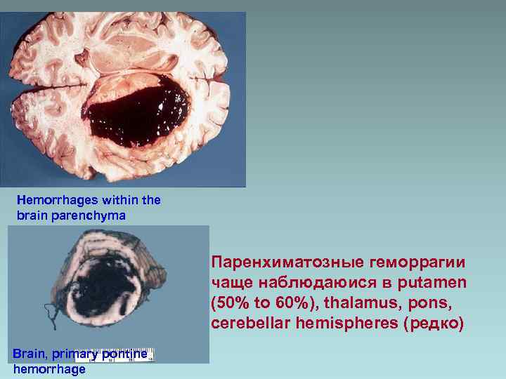 Hemorrhages within the brain parenchyma Паренхиматозные геморрагии чаще наблюдаюися в putamen (50% to 60%),