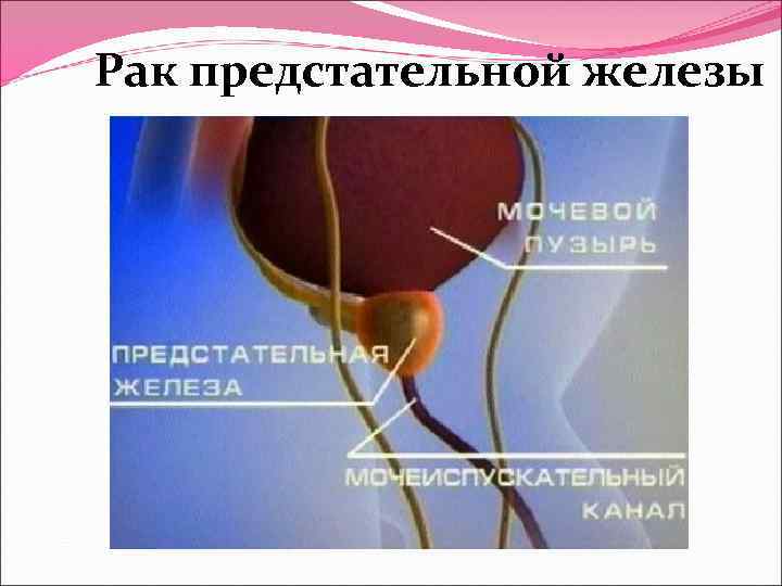 Рак предстательной железы 