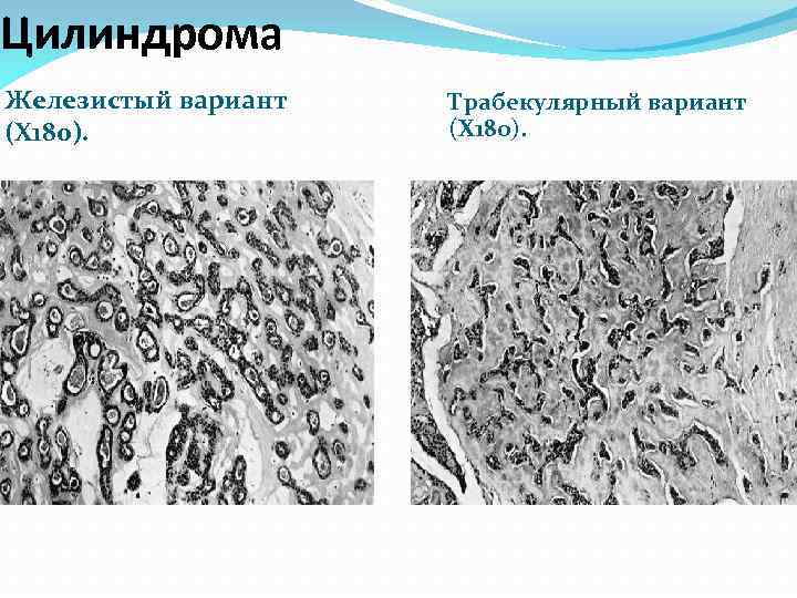 Цилиндрома Железистый вариант (Х 180). Трабекулярный вариант (Х 180). 