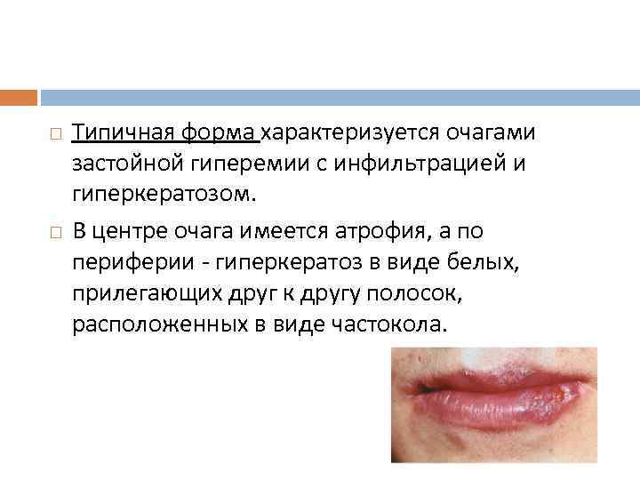  Типичная форма характеризуется очагами застойной гиперемии с инфильтрацией и гиперкератозом. В центре очага