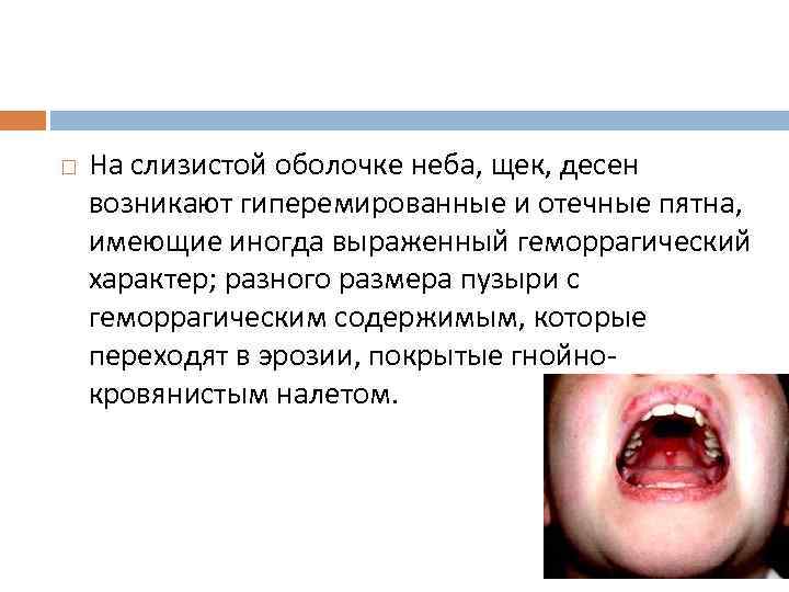  На слизистой оболочке неба, щек, десен возникают гиперемированные и отечные пятна, имеющие иногда