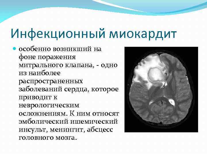 Инфекционный миокардит особенно возникший на фоне поражения митрального клапана, - одно из наиболее распространенных