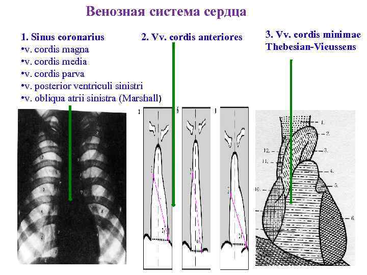 Венозная система сердца 1. Sinus coronarius 2. Vv. cordis anteriores • v. cordis magna