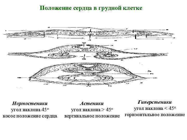 Положение сердца в грудной клетке Нормостеники угол наклона 45 о косое положение сердца Гиперстеники