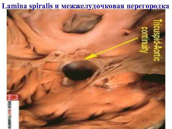 Lamina spiralis и межжелудочковая перегородка 