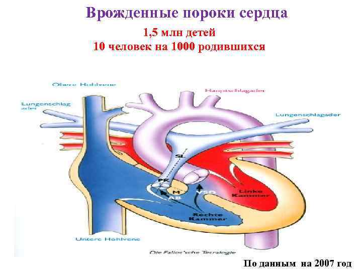 Врожденные пороки сердца 1, 5 млн детей 10 человек на 1000 родившихся По данным