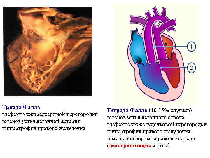 Триада фалло презентация