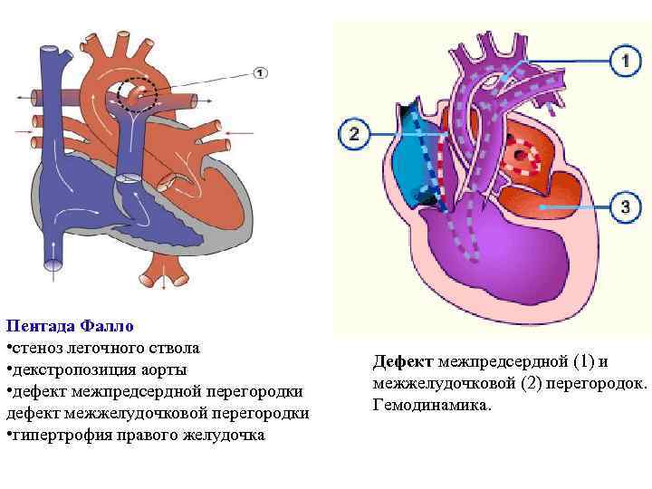 Дефект межжелудочковой перегородки гемодинамика схема