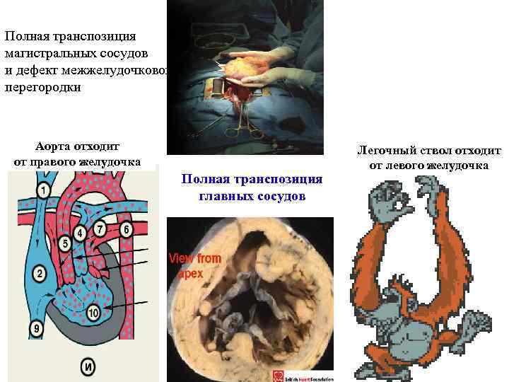 Полная транспозиция магистральных сосудов и дефект межжелудочковой перегородки Аорта отходит от правого желудочка Полная