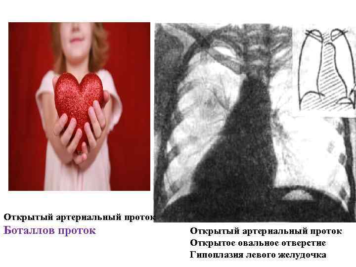 Открытый артериальный проток Боталлов проток Открытый артериальный проток Открытое овальное отверстие Гипоплазия левого желудочка