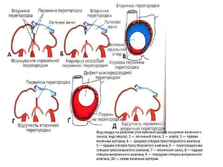 Вид сердца на разрезах (поперечный разрез на уровне венечного синуса, вид сверху): 1 —