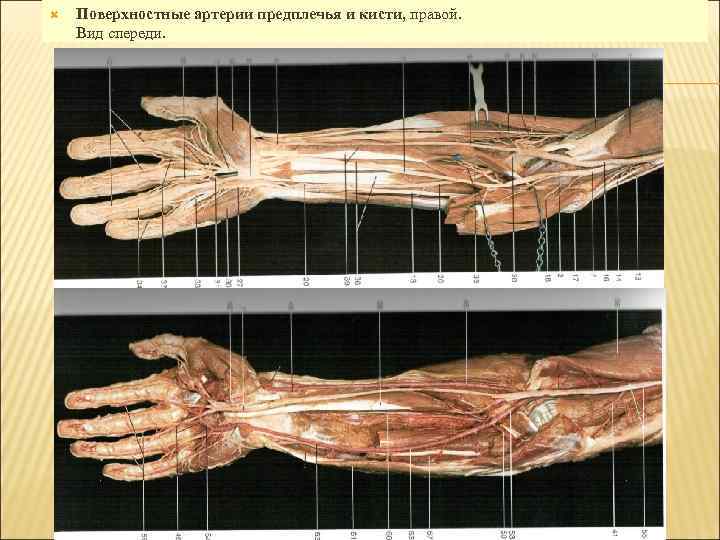  Поверхностные артерии предплечья и кисти, правой. Вид спереди. 