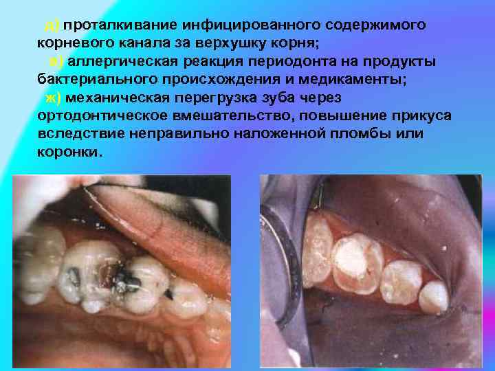 д) проталкивание инфицированного содержимого корневого канала за верхушку корня; е) аллергическая реакция периодонта на