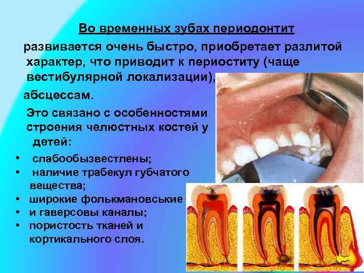 Во временных зубах периодонтит развивается очень быстро, приобретает разлитой характер, что приводит к периоститу