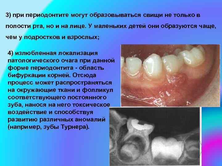 3) при периодонтите могут образовываться свищи не только в полости рта, но и на