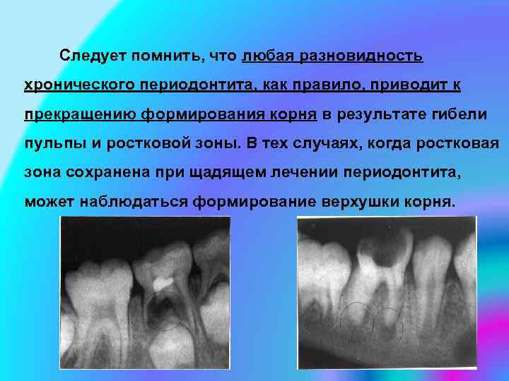  Следует помнить, что любая разновидность хронического периодонтита, как правило, приводит к прекращению формирования