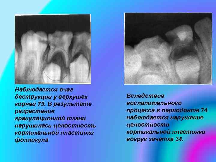 Наблюдается очаг деструкции у верхушек корней 75. В результате разрастания грануляционной ткани нарушилась целостность