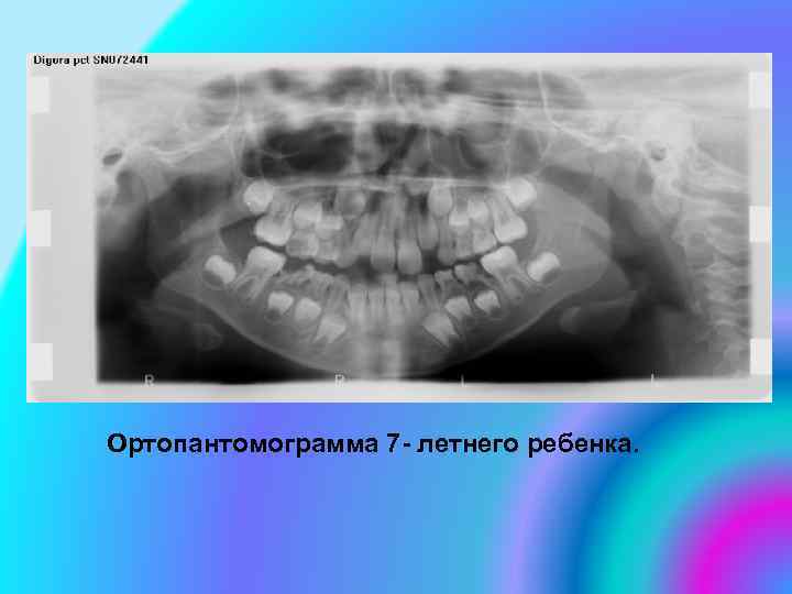 Ортопантомограмма 7 - летнего ребенка. 