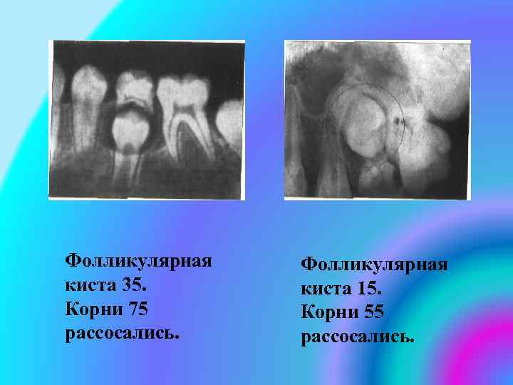 Фолликулярная киста 35. Корни 75 рассосались. Фолликулярная киста 15. Корни 55 рассосались. 