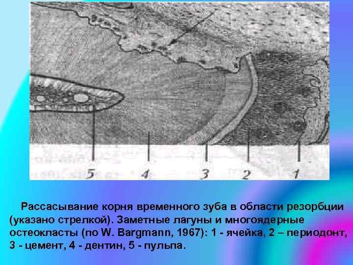 Рассасывание корня временного зуба в области резорбции (указано стрелкой). Заметные лагуны и многоядерные остеокласты