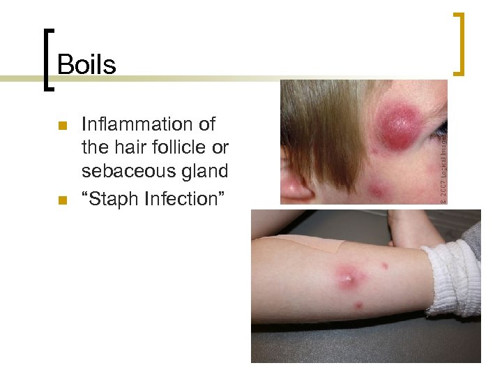 Boils n n Inflammation of the hair follicle or sebaceous gland “Staph Infection” 