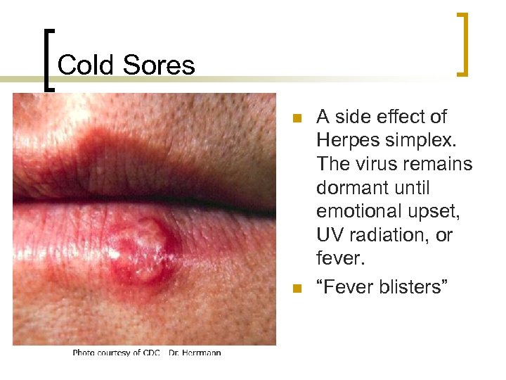 Cold Sores n n A side effect of Herpes simplex. The virus remains dormant