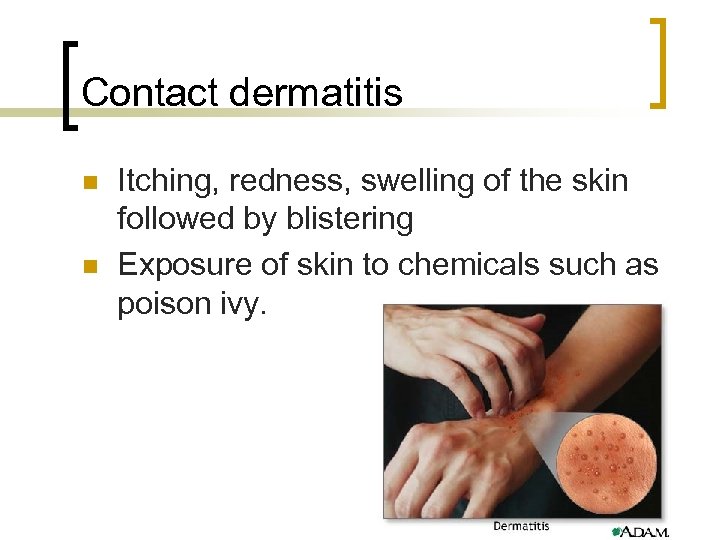 Contact dermatitis n n Itching, redness, swelling of the skin followed by blistering Exposure