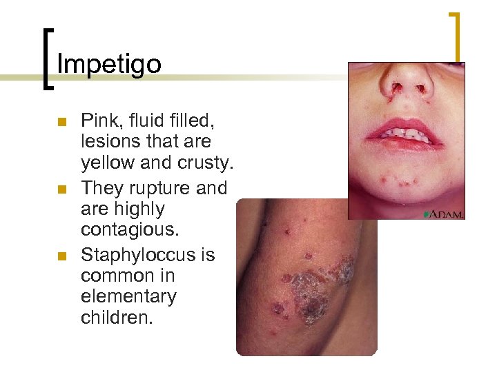 Impetigo n n n Pink, fluid filled, lesions that are yellow and crusty. They