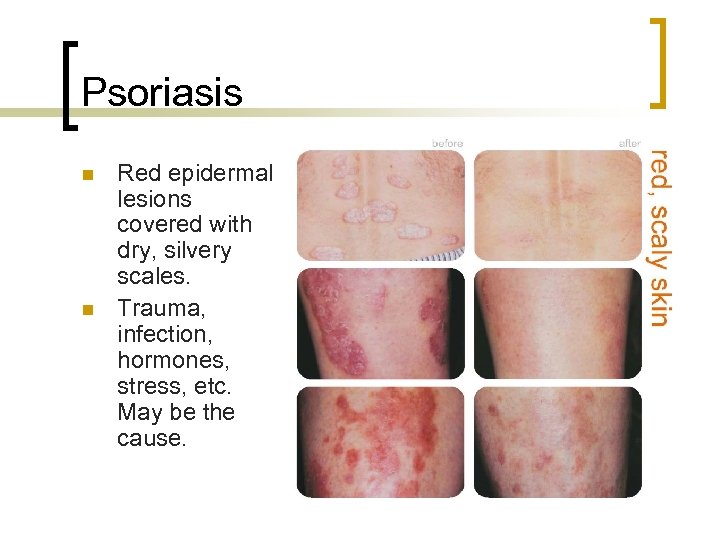 Psoriasis n n Red epidermal lesions covered with dry, silvery scales. Trauma, infection, hormones,