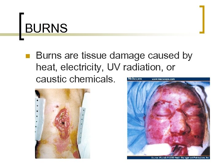 BURNS n Burns are tissue damage caused by heat, electricity, UV radiation, or caustic