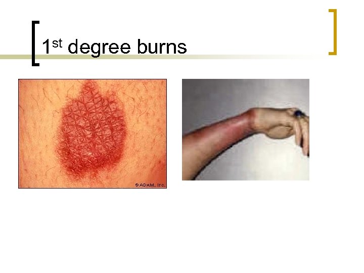 1 st degree burns 