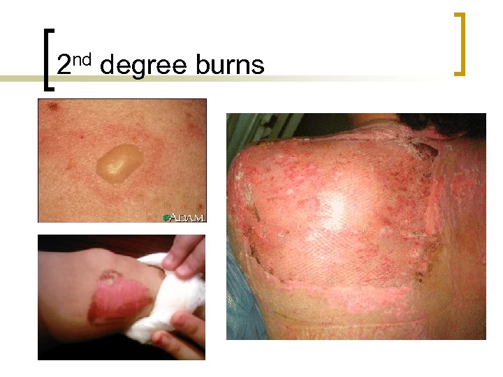 2 nd degree burns 