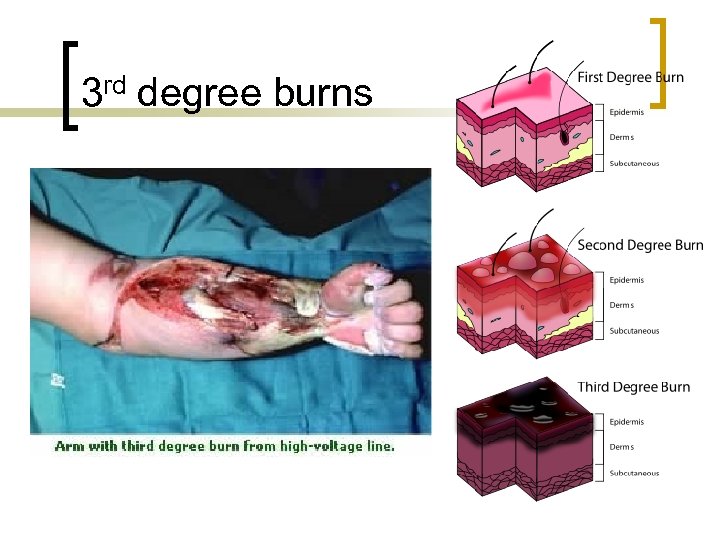 3 rd degree burns 