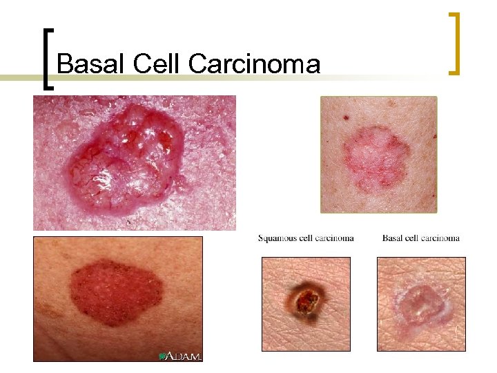 Basal Cell Carcinoma 