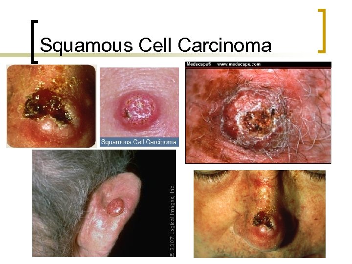 Squamous Cell Carcinoma 