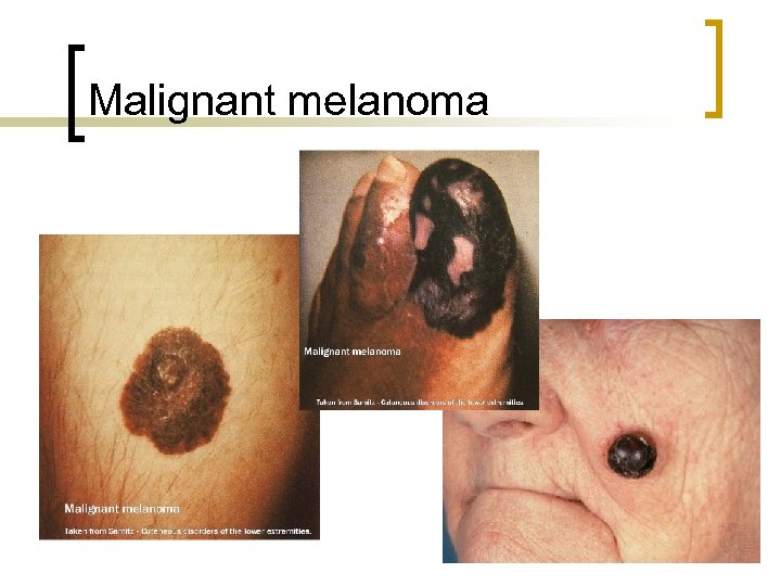 Malignant melanoma 