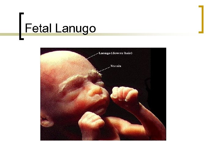 Fetal Lanugo 