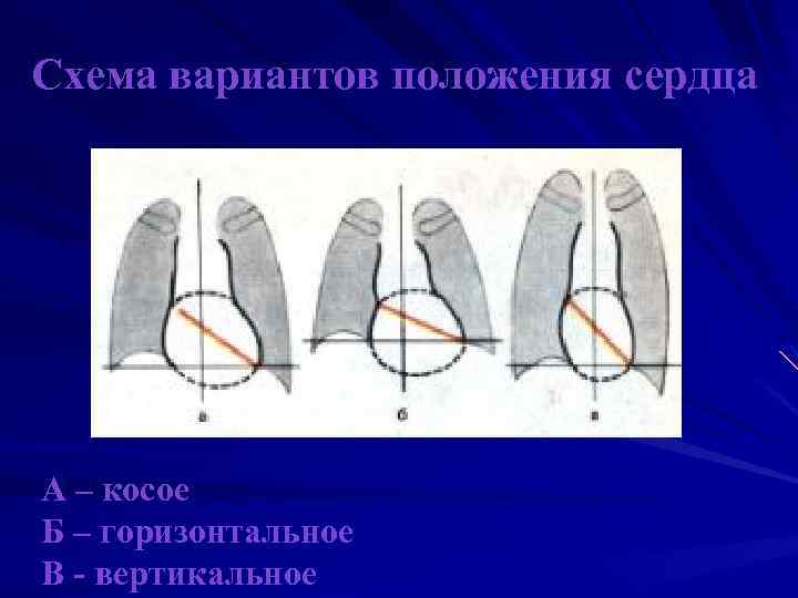 Схема вариантов положения сердца А – косое Б – горизонтальное В - вертикальное 