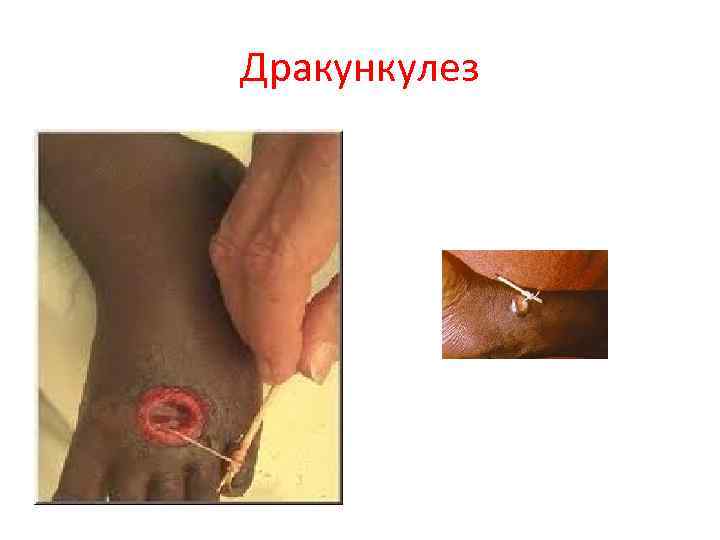 Дракункулез 