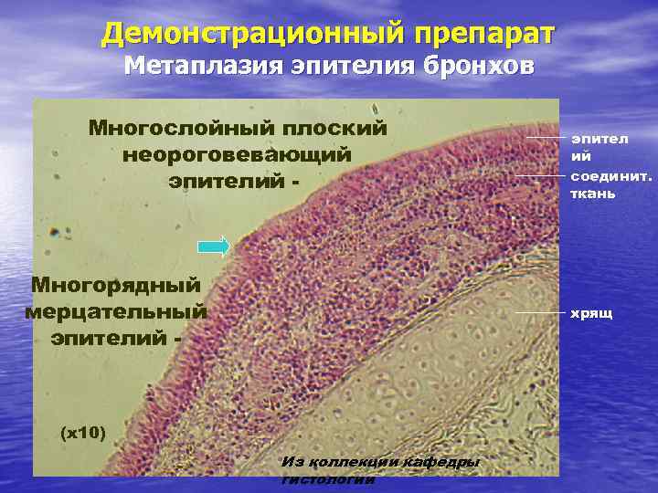 Реактивные изменения метаплазированных клеток. Метаплазия эпителия бронхов микропрепарат.