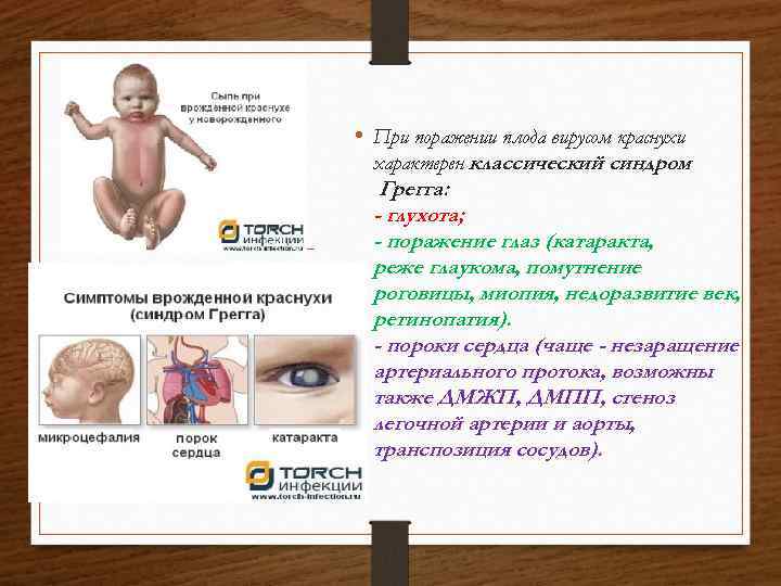  • При поражении плода вирусом краснухи характерен классический синдром Грегга: - глухота; -